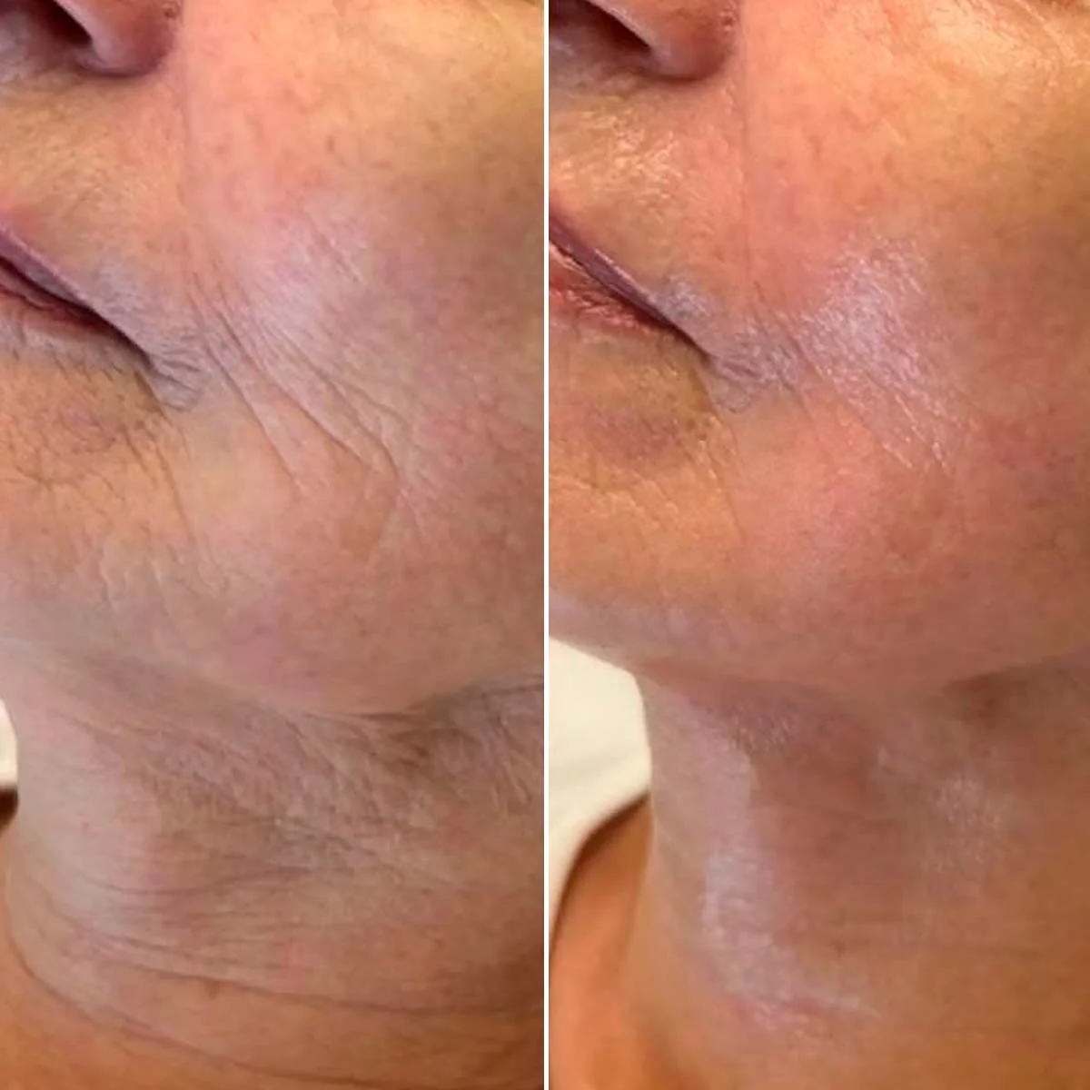 Facial Antiage