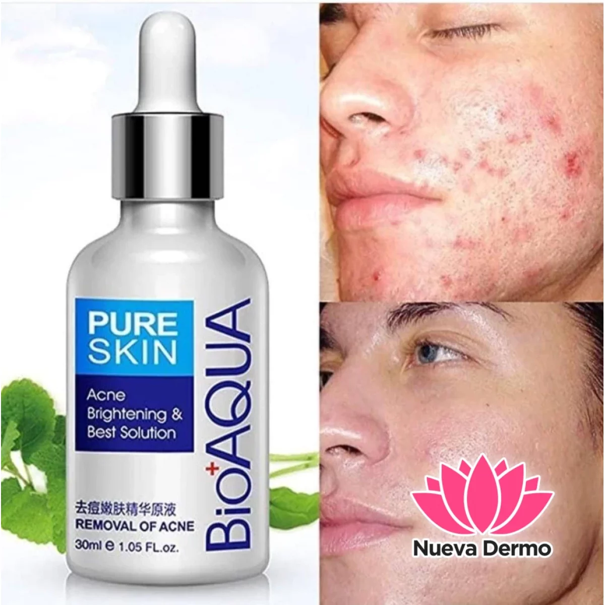 Serum Removal of acne 30ml (Bioaqua)